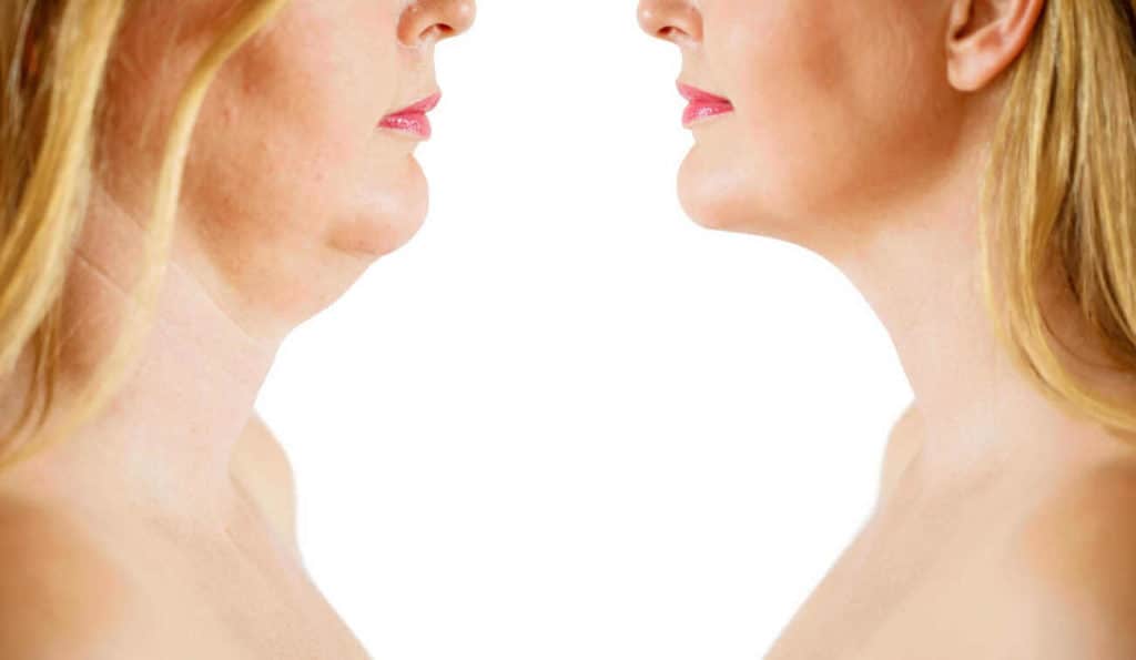 Double Chin treatment SCOTLAND before and after results