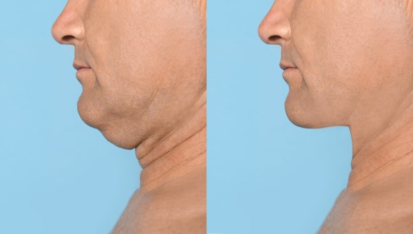 Which Non-Surgical Treatments Work Best for Jowls and Loose Skin SCOTLAND?