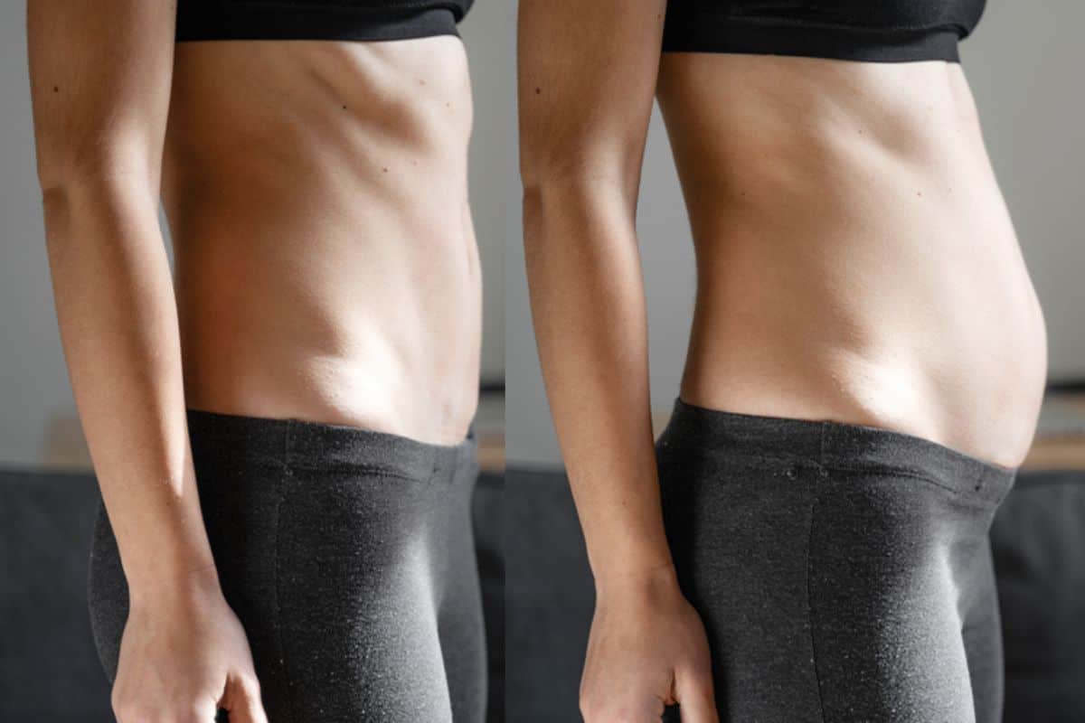 How long does diastasis recti take to improve SCOTLAND?