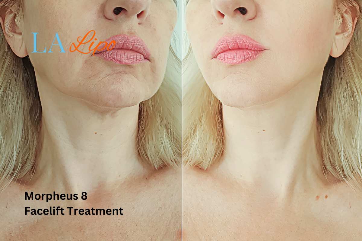 Turn back time with Morpheus8 Treatment SCOTLAND