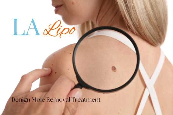 Woman having her inspection of blemish before mole removal SCOTLAND
