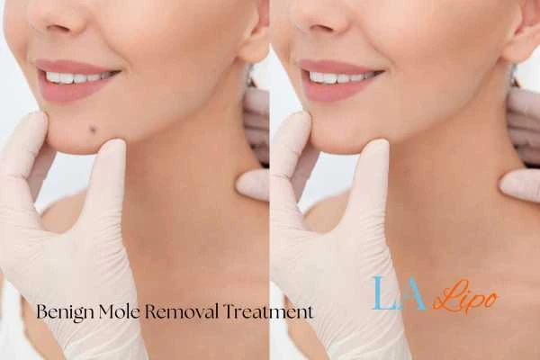 Before and after mole removal SCOTLAND treatment