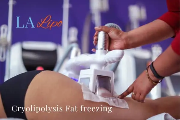 women getting fat freezing SCOTLAND