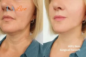 hi-fu for wrinkles SCOTLAND before and after results