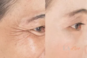 Before and after results of woman - HI-fu wrinkles reduction treatment SCOTLAND