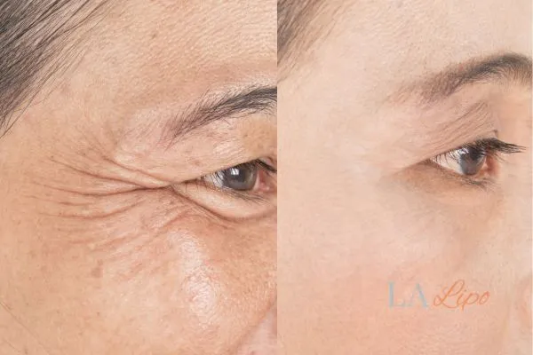 Before and after results of woman - HI-fu wrinkles reduction treatment SCOTLAND