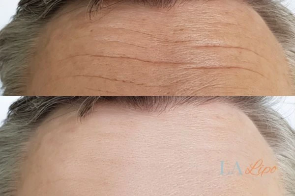 results of HIFU SCOTLAND on mans forehead to help reduce lines and wrinkles