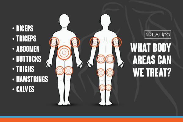 Graphic to show areas you can have LA-EMS Body Sculpting SCOTLAND treatment.