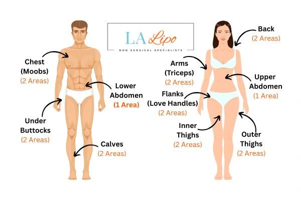 LA LIPO Cryolipolysis Areas SCOTLAND