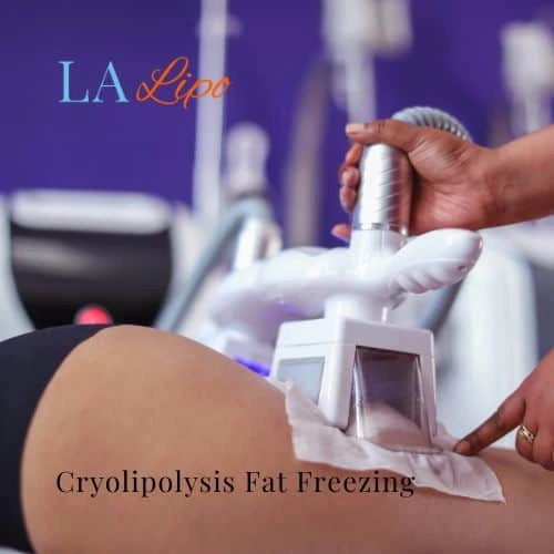 fat freezing - Cryolipolysis SCOTLAND