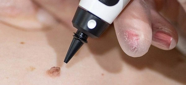 skin tag removal using cryopen SCOTLAND
