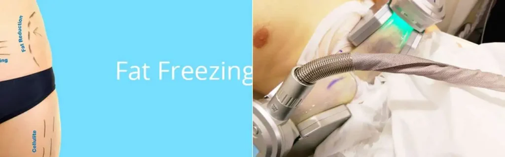 multi areas of a persons body having coolsculpting SCOTLAND treatment