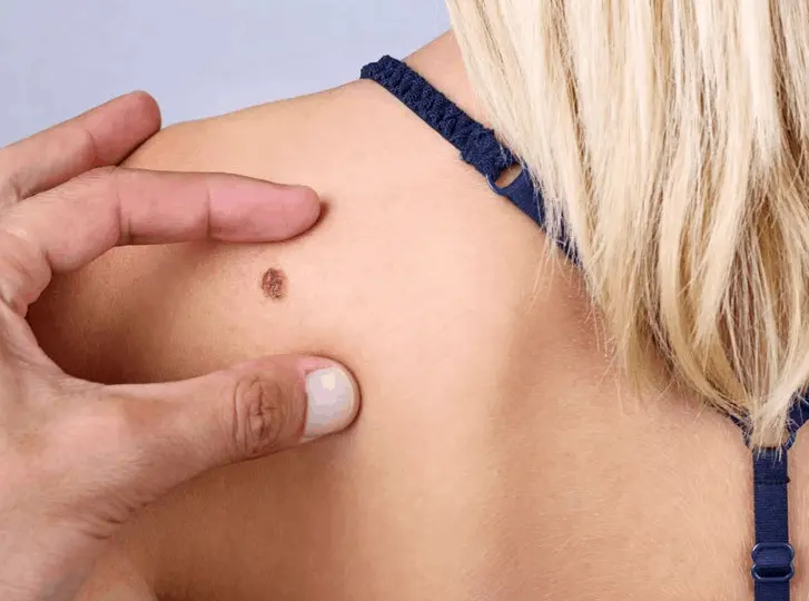 woman having mole removal SCOTLAND consultation before treatment.