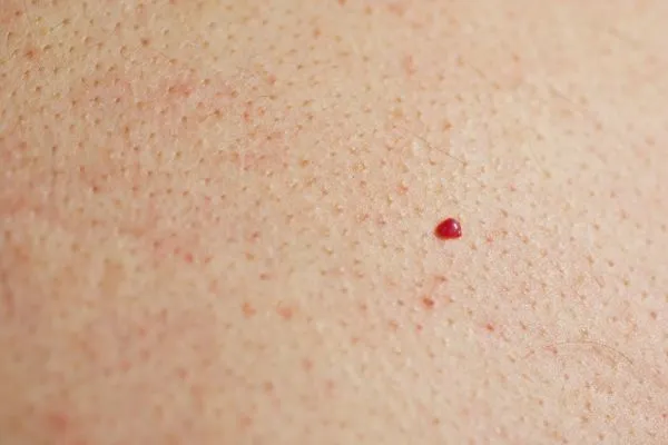 close up of a cherry angioma SCOTLAND