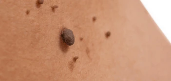 image of a skin tag SCOTLAND