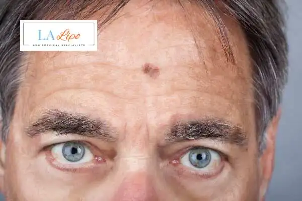 Solar Lentigo Removal SCOTLAND image of man with mark on his forehead