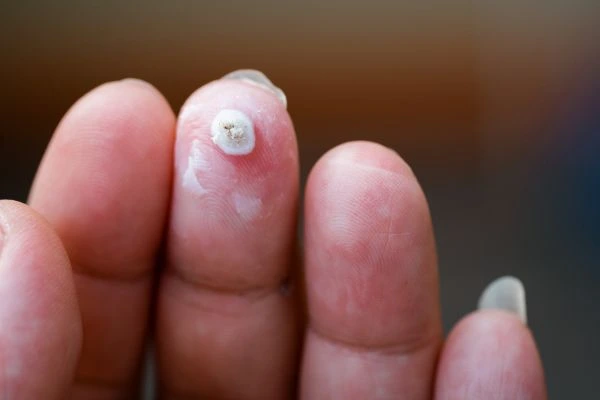 wart on person finger - cryotherapy to treat from LA LIPO SCOTLAND
