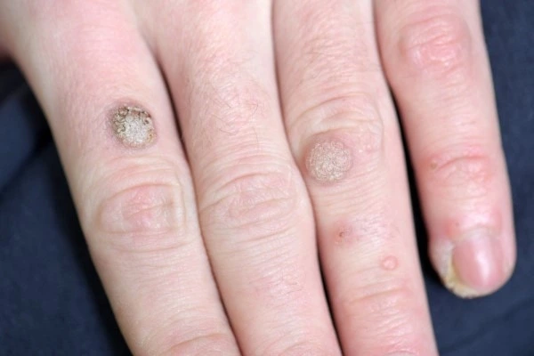 photo of warts on person hand - see wart removal SCOTLAND from LA LIPO