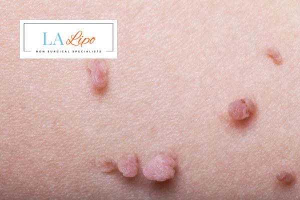Does cryopen skin tag removal SCOTLAND hurt? Find out now call our team today!