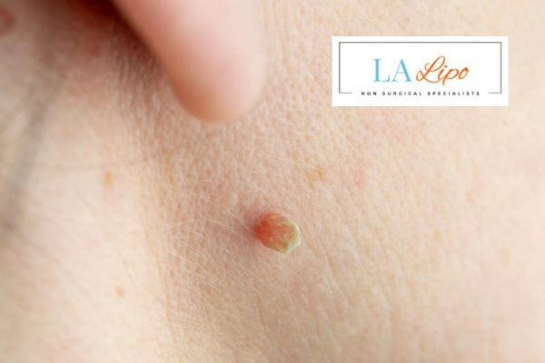 Book skin tag removal SCOTLAND today speak to our team now!