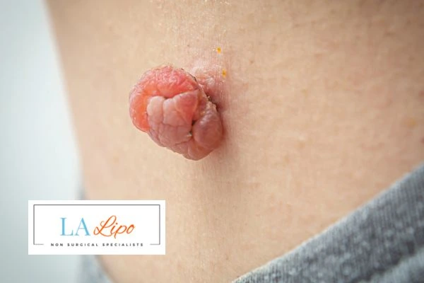 Interested in skin tag removal SCOTLAND? Concerned about the pain? Find out more today!
