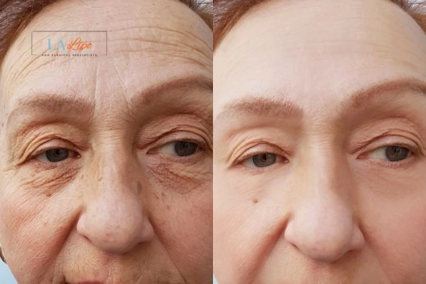 The powerful benefits of Morpheus8 Treatment SCOTLAND - Call Our team today!