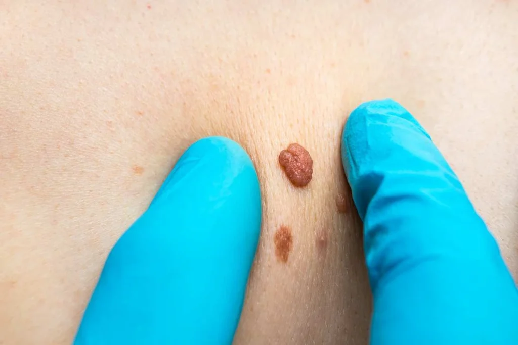 LA LIPO Cryopen Lesion Removal Prices SCOTLAND