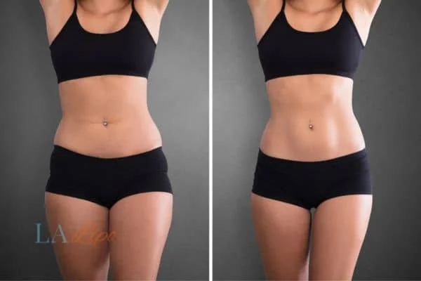before and after results of non-surgical treatment to help a woman's body image and mental health SCOTLAND