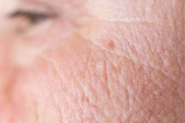 close up picture of a woman's face showing an age spot SCOTLAND