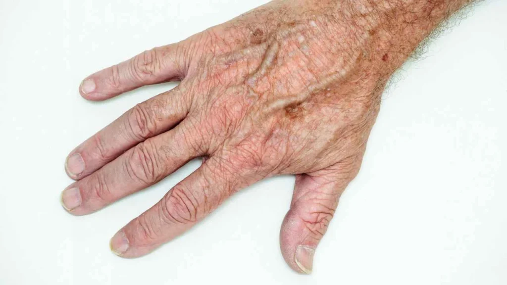 Male hand showing age spot SCOTLAND