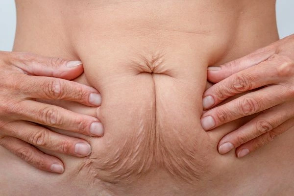 Image of a woman's stomach with loose skin - example of skin tightening SCOTLAND options