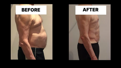 What Symptoms Can Diastasis Recti Cause in Men? Weak Core, Back Pain and Poor Posture SCOTLAND